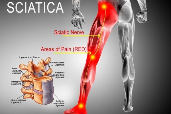 درد سیاتیک